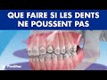 DENT INCLUSE - Que faire si les CANINES ou autres dents permanentes ne rentrent pas ©