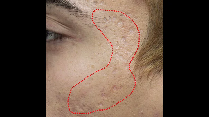 Acne Scar Treatment - DayDayNews