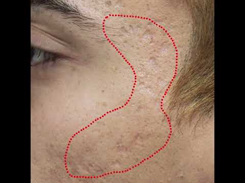 Hollywood Acne Treatments