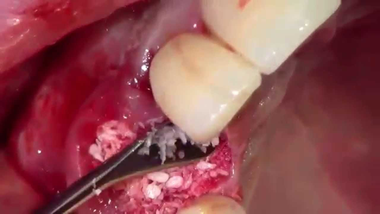 Tooth Extraction with Simple Socket Grafting (AS)