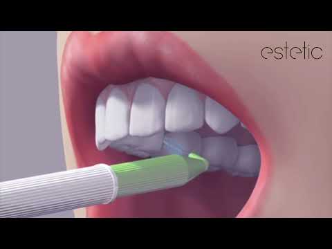 Video: Može li zvučna četkica oštetiti zube?