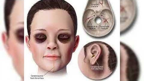 How the HANS Device protects a Race Car Driver - Explained, how hans device works