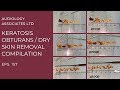 KERATOSIS OBTURANS/DRY SKIN REMOVAL COMPILATION - EP 157