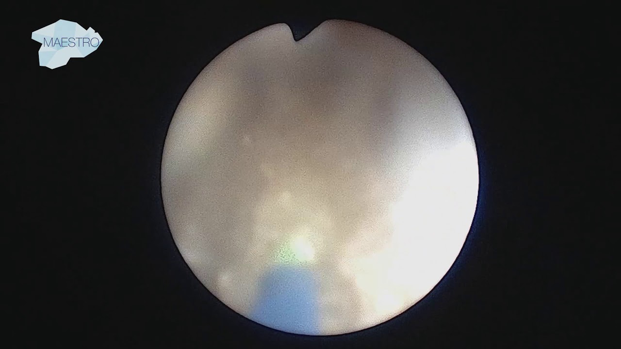 Lithotripsy Technique for Cystine Stone YouTube