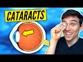 Cataracts Explained Simply - Symptoms, Causes, Treatments