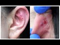 DON'T WATCH THIS Piercing Removal If You Have A Weak Stomach!! 🤢