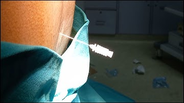 Best technique of spinal anaesthesia