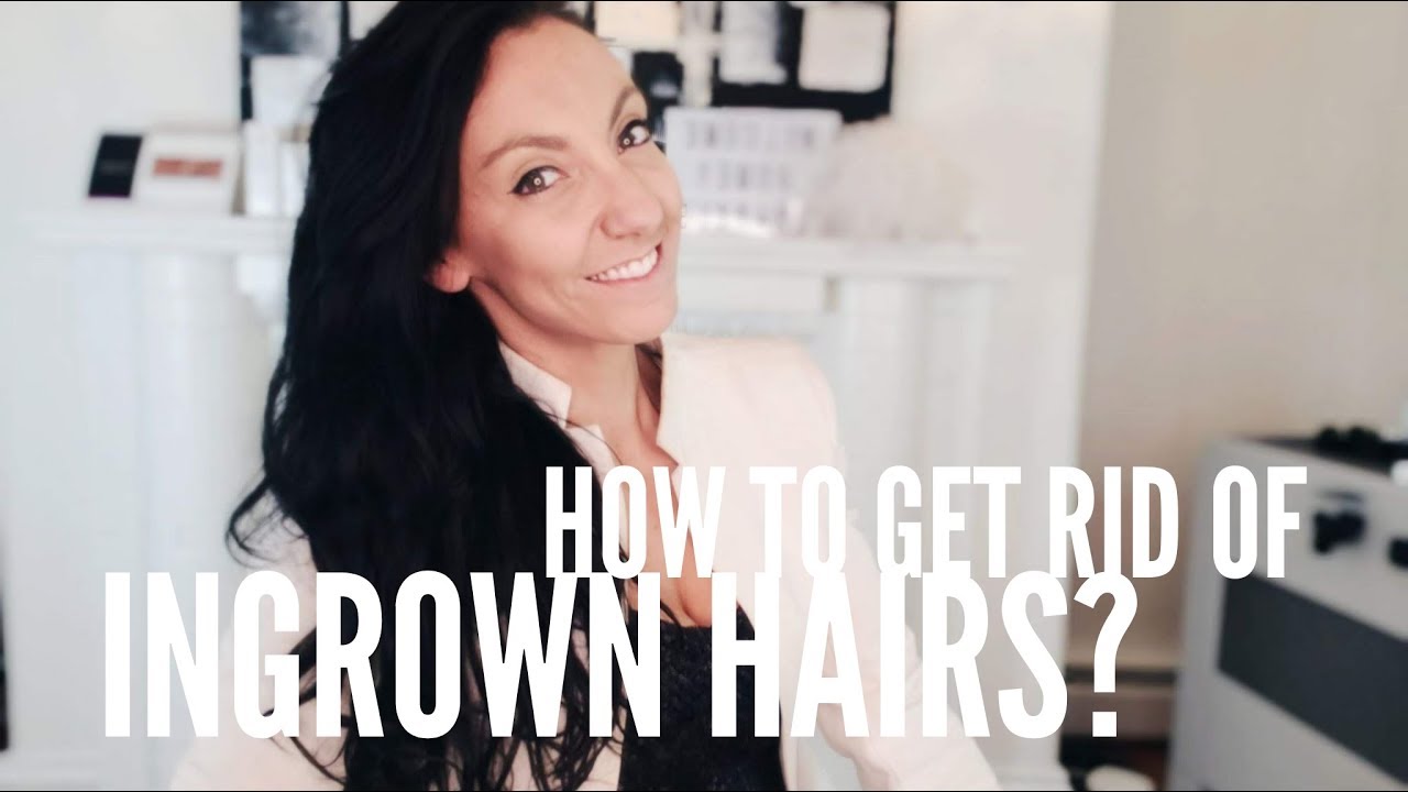 How to get rid of ingrown hair - YouTube