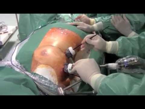 Ablazione chirurgica della fibrillazione atriale