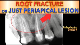 EASY How to Differentiate between Periapical Radiolucencies or Root Fractures