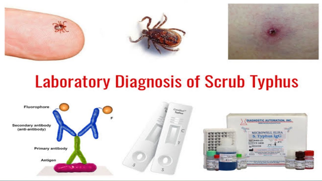 ⁣scrub typhus/How do you identify scrub typhus/ scrub typhus position negative test/scrub typhus test