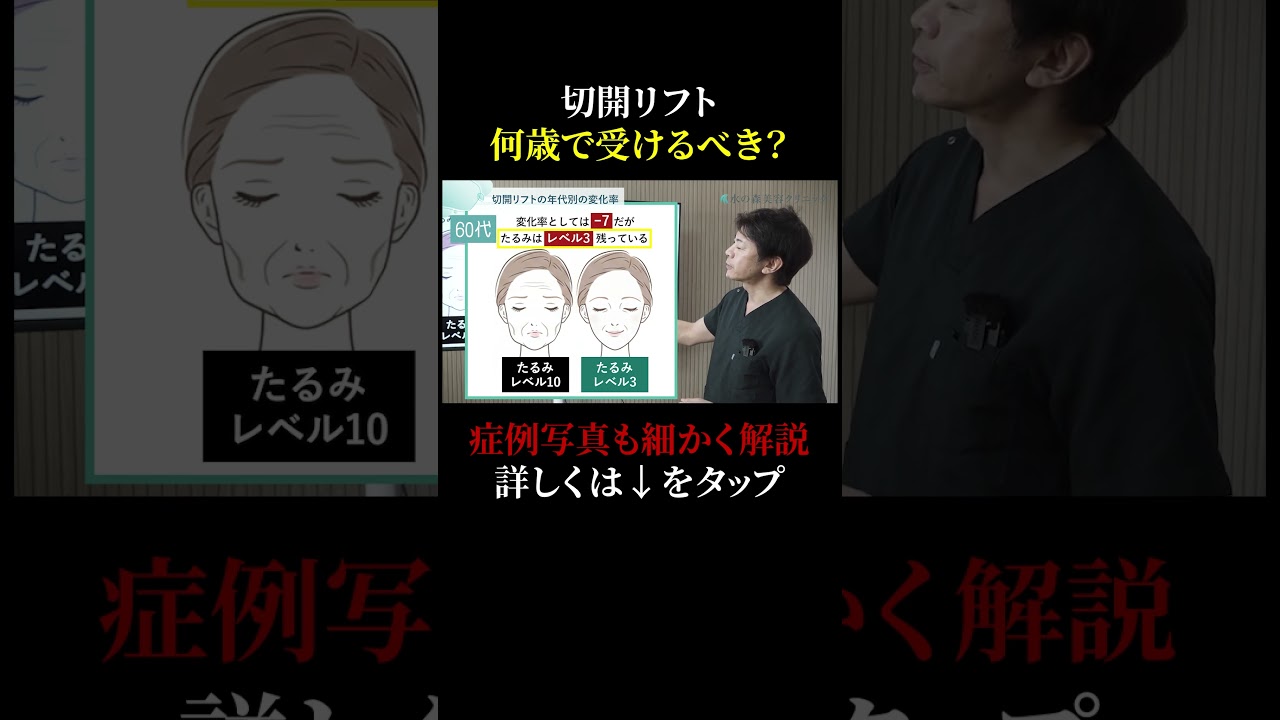切開リフト何歳からできるの?#アンチエイジング #切開リフト