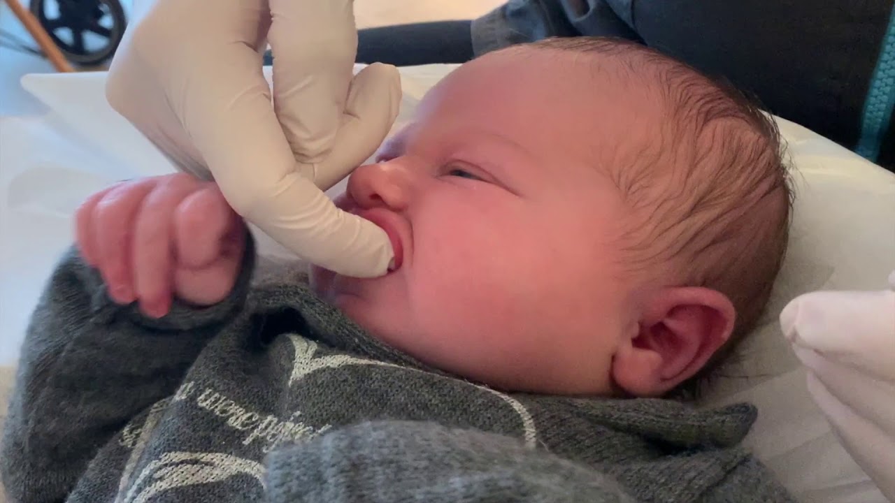 Exercices pour le frein de lèvre supérieure avant et après freinectomie chez un bébé