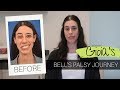 Gioias story  bells palsy surgery  dr babak azizzadeh