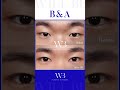 WILLBE 절개눈매교정+앞트임 B&amp;A☘️  #윌비성형외과 #김준영원장 #willbe #beforeandafter #눈성형잘하는곳 #남자눈매교정 #눈매교정후기 #눈성형전후