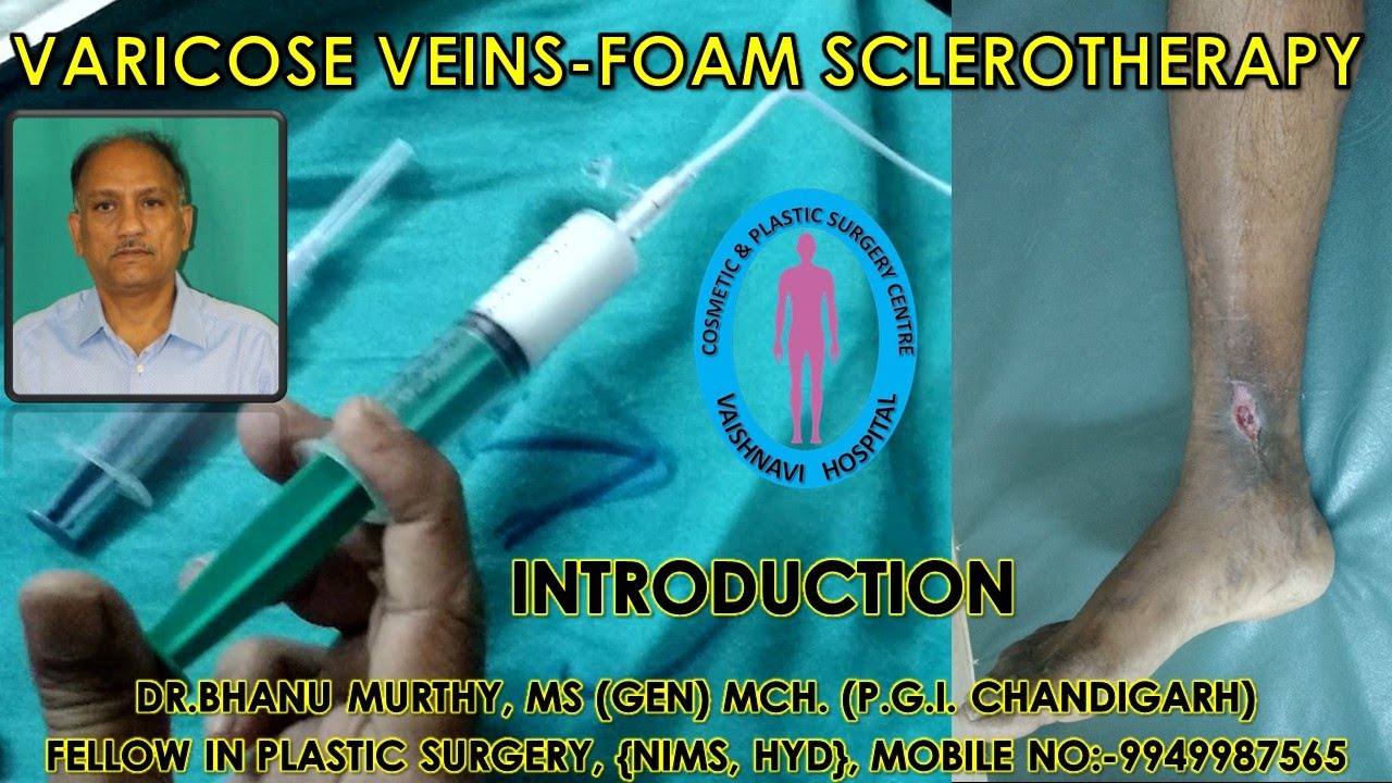 Varicose Veins Foam Sclerotherapy Drm Bhanumurthy Vaishnavi Super