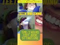 दांत सफेद करने का Professional तरीका जेड Teeth whitening at Clinic-Time,procedure,sittings
