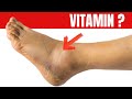 No1 vitamin for removing leg and foot swelling