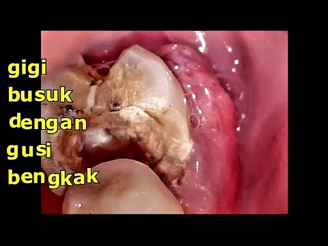 Obat Sakit Gigi Alami yang Paling Mujarab! │ Hidup Sehat. 