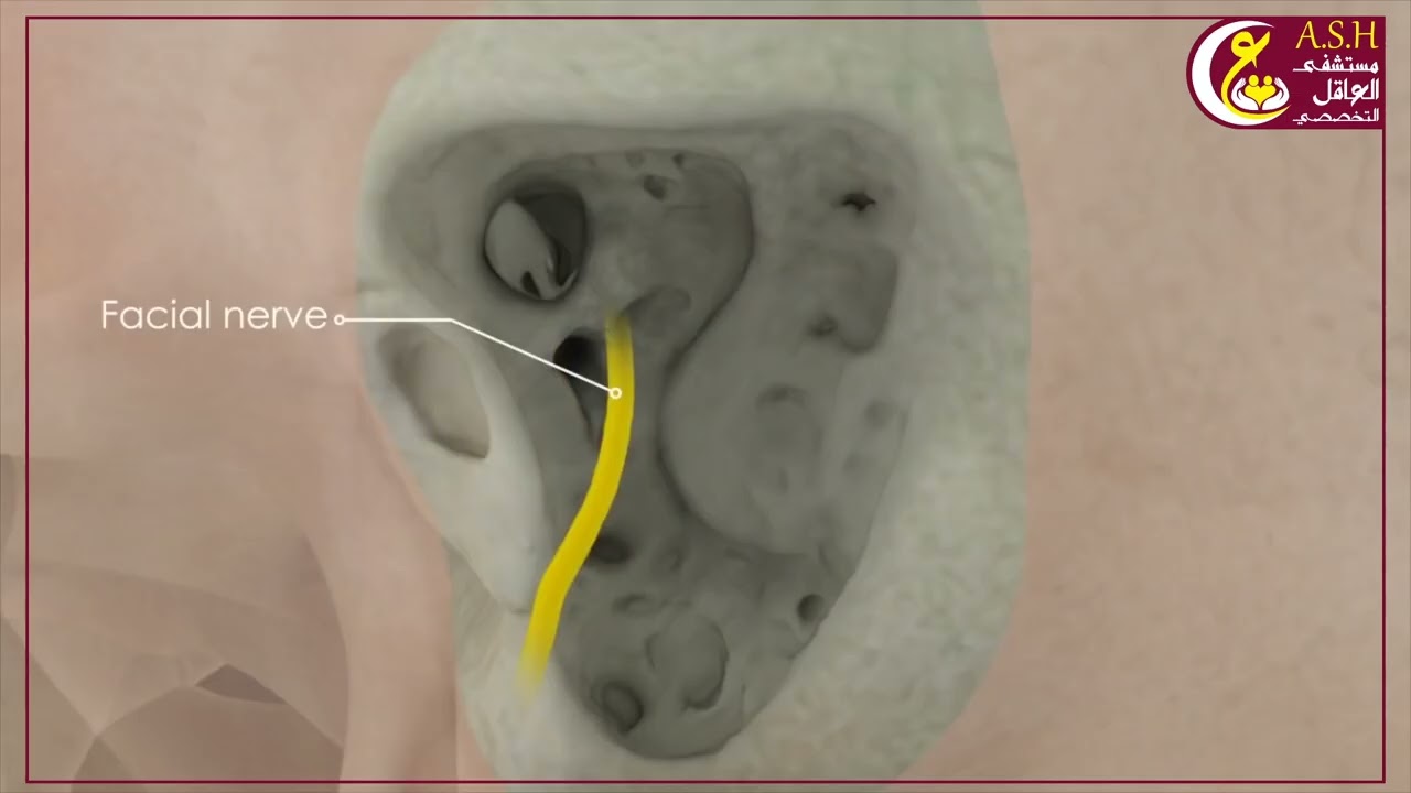 تسوس الأذن الوسطى