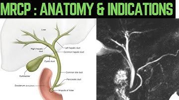 MRCP: MRI in gall bladder stone, bile duct stone, jaundice and anatomy of biliary tree #jaundice