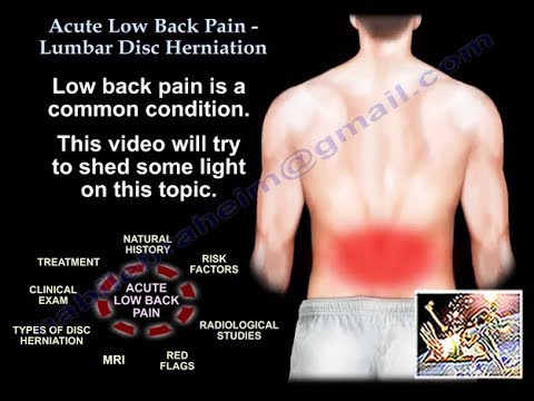 Acute Low Back Pain , Lumbar Disc Herniation - Everything You Need To Know - Dr. Nabil Ebraheim