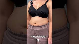 22 Yıllık Meme Protezi Yenilendi 4. Günde Büyük Değişim