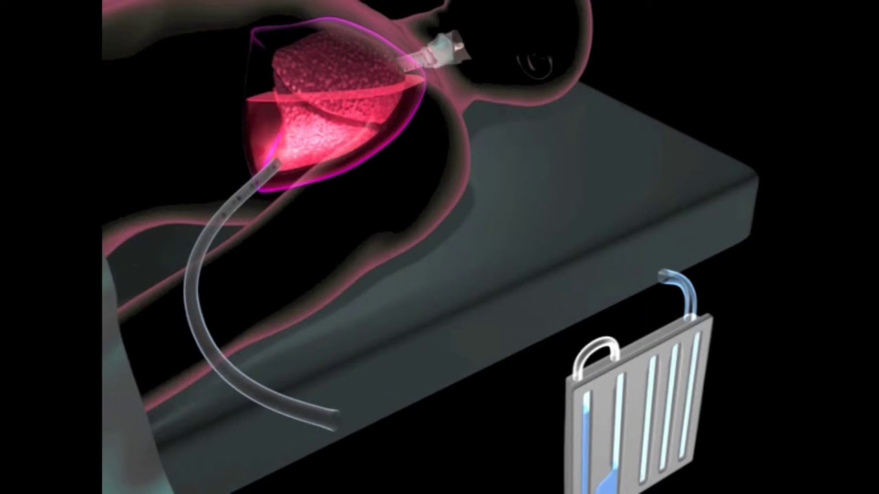 PleuraFlow Active Clearance Technology