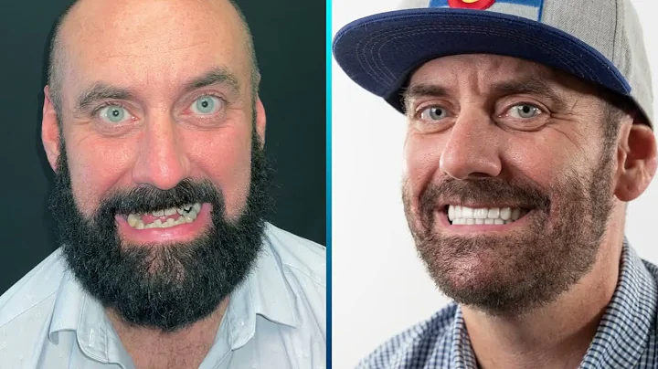 Before and After Smile Transformation | Smile Makeover