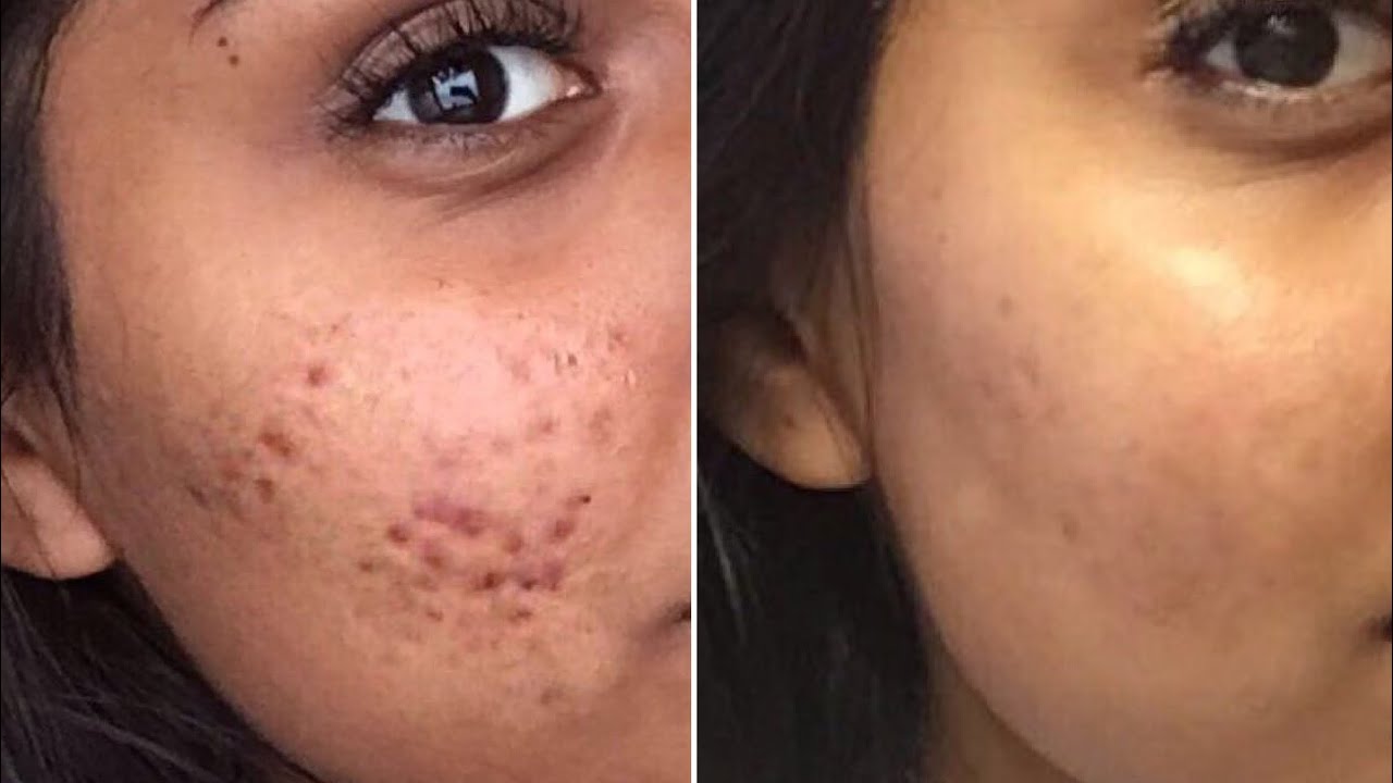 Subcisão Para Cicatriz De Acne Preço ESSE TRATAMENTO FACIAL REMOVE ATÉ CICATRIZES!!!?? - YouTube