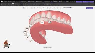 Angle Class III Malocclusion Clear Aligner Treatment Case - Best Smile Tech