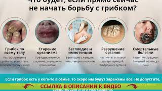 ⛔ Грибок ног домашними средствами 💯 Как в домашних условиях можно вылечить грибок на ногах ❗