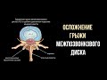 Осложнение грыжи поясничного отдела позвоночника - синдром конского хвоста. Удаление грыжи диска