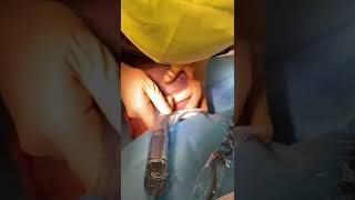 Extraction folliculaire