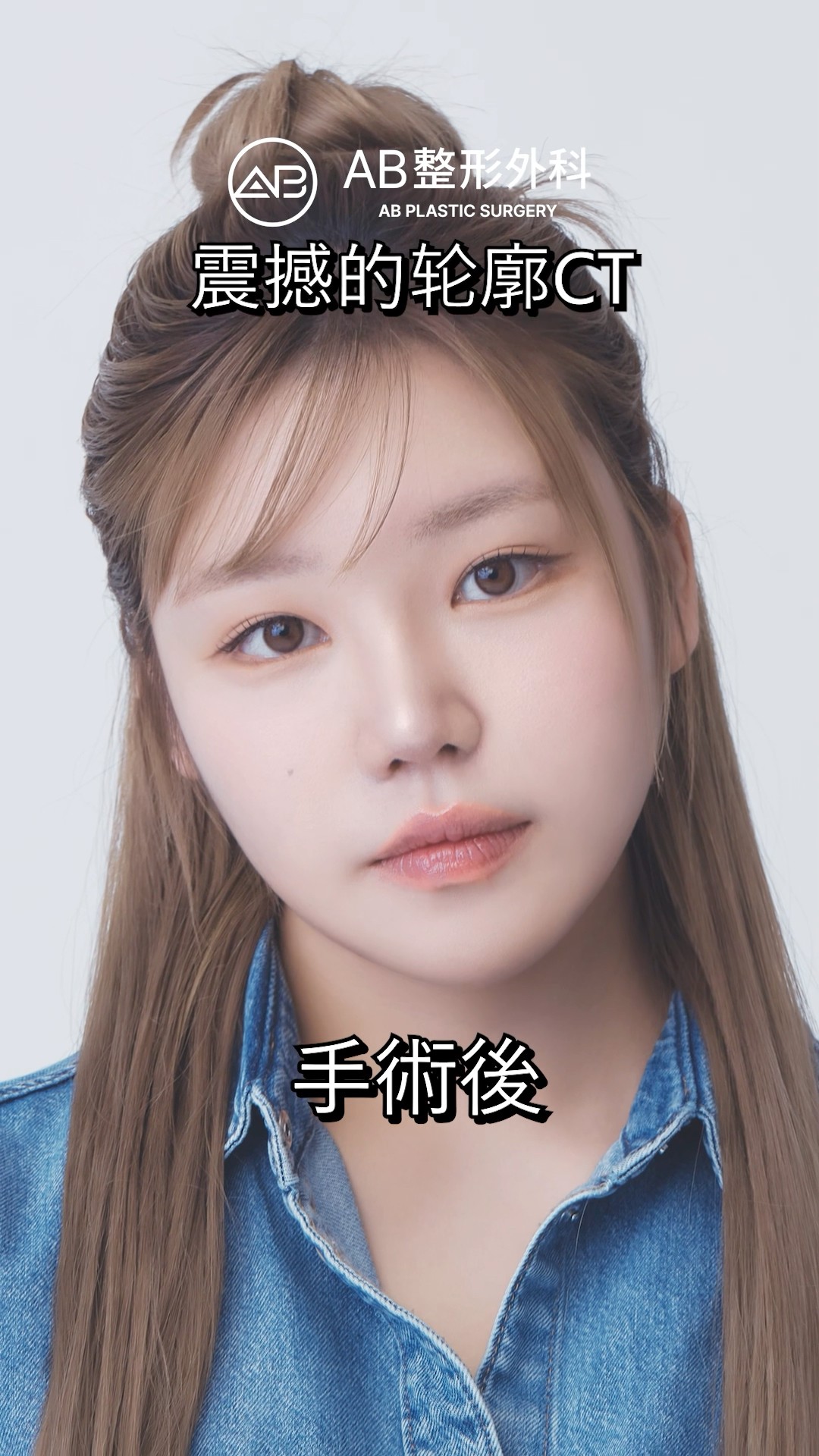 輪廓手術真實成果【CT公開】 #shorts