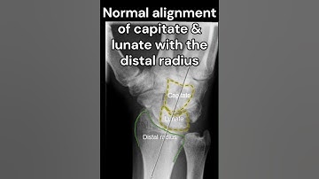Scaphoid waist fracture with no perilunate dislocation