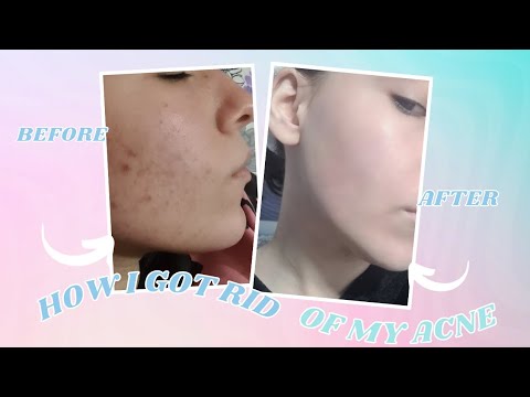 How I got rid of my acne *amazing products I used* |Tesy - YouTube