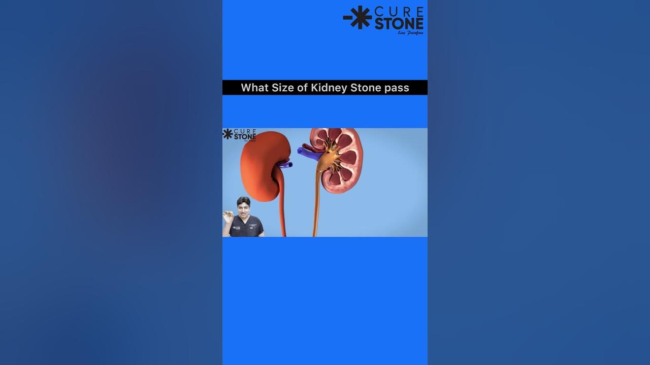 what-size-of-kidney-stone-can-pass-naturally-trending-viral