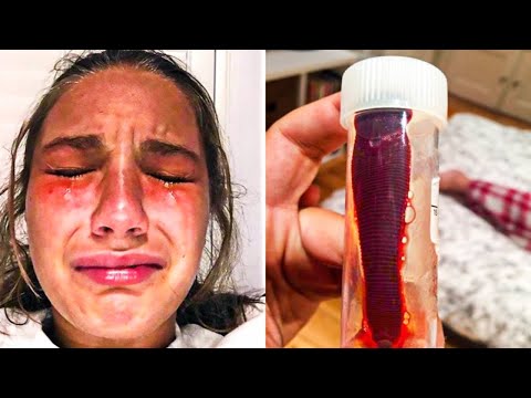 გოგონას ეგონა რომ ცხვირში რაღაც გაეჭედა . მაგრამ ექიმებმა მისი ცხვირიდან ეს საშინელი რამ გამოიღეს .