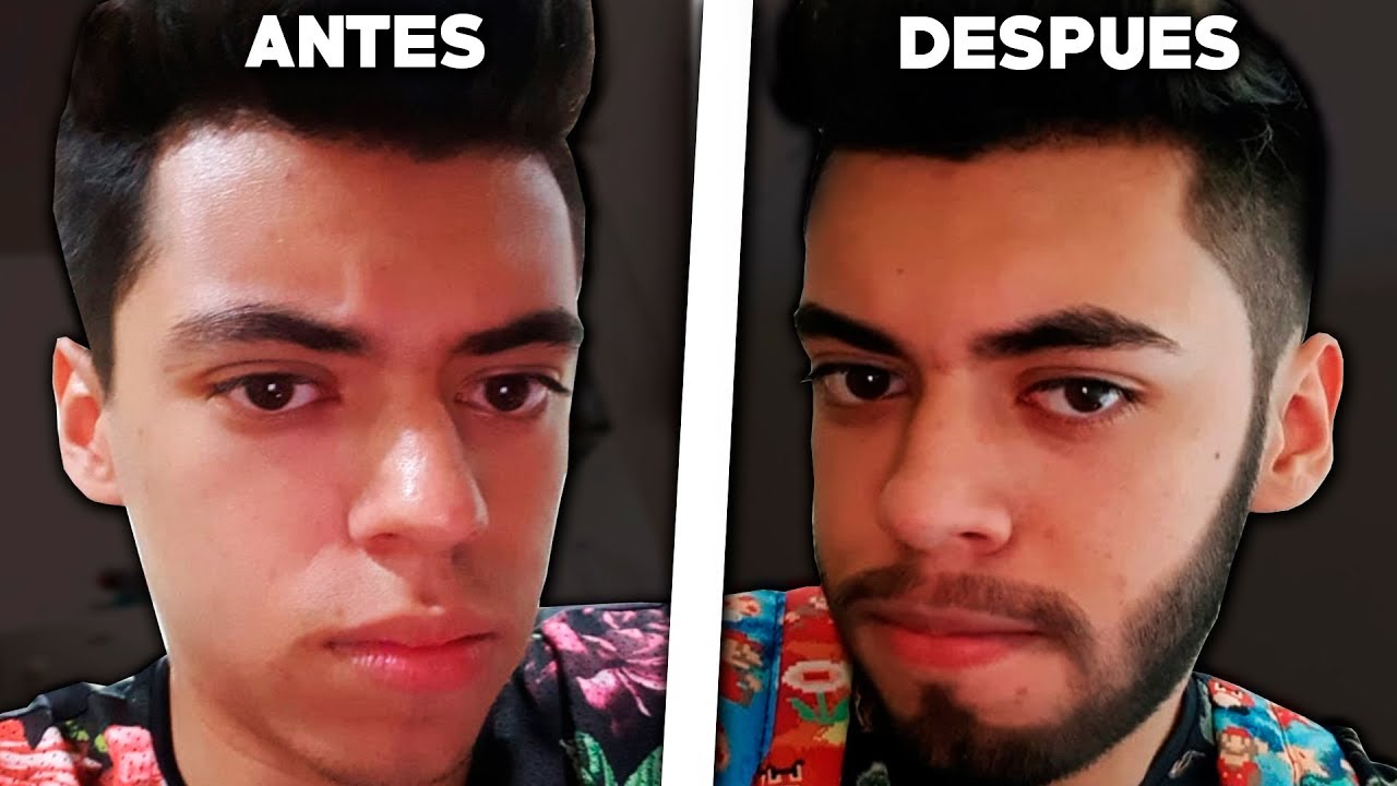 Usé MINOXIDIL Por 4 MESES