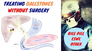 Treating Gallstones WITHOUT Surgery