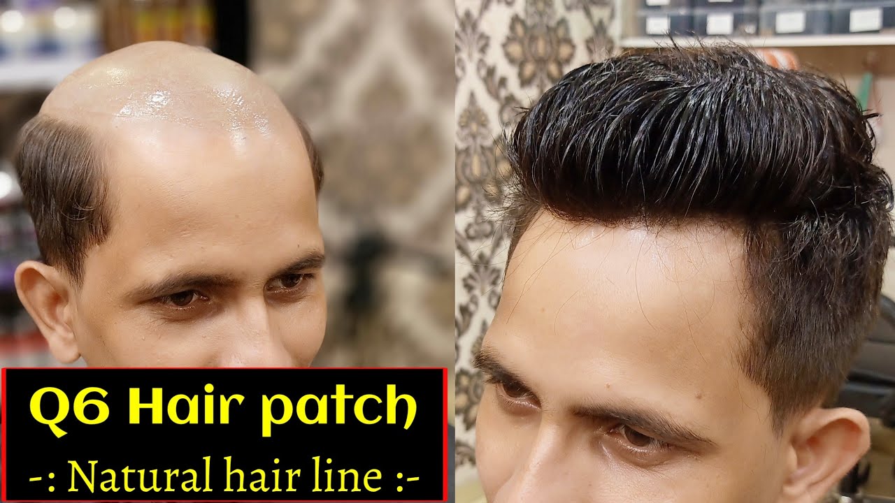 Latest Natural Hair Line Patch IN INDIA BEST HAIR PATCH IN INDIA, HAIR PATCH IN RAIPUR