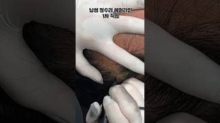 남성 헤어라인,정수리 두피문신 1차 작업.(인더스칼프 당진&amp;평택)