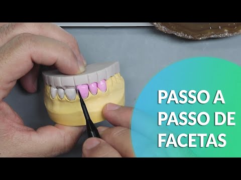 Vídeo: Qual a espessura das facetas de pedra?