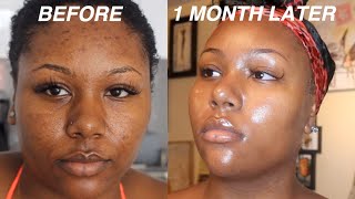 I FADED MY ACNE SCARS + GOT CLEAR SKIN DOING THIS FOR 1 MONTH! VIDEO PROOF | SKINCARE ROUTINE
