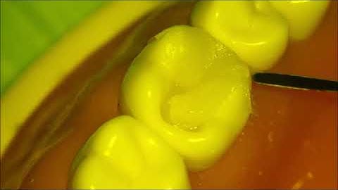 composite class 2 with injection molding technique