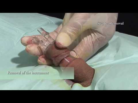 Adult Circumcision Process 109