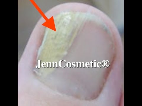Nagel Ziehen 22 02 14 Youtube Tips Anbringen