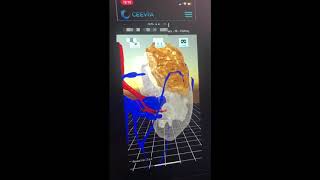 Telehealth surgical consultations using Ceevra’s AI-driven 3D models.