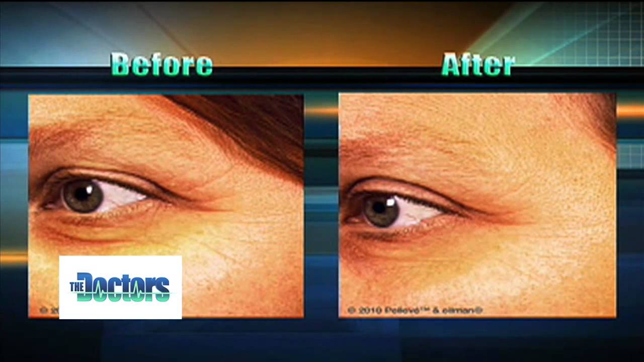 pelleve radio frequency skin tightening - YouTube
